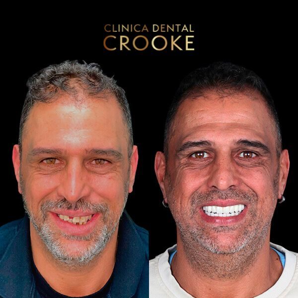 Antes y después del tratamiento, a la izquierda antes y a la derecha después: prótesis fija completa sobre implantes