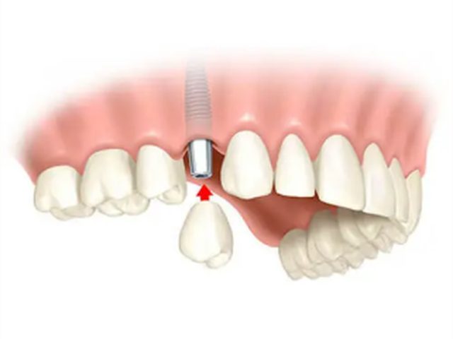 Implante dental unitario colocado en el hueco de un diente perdido