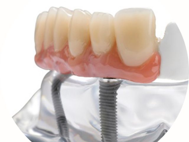 Implante dental colocado sobre modelo anatómico